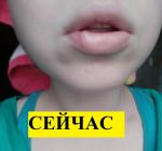 Травма губы (последствия спустя месяц) фото 18+ фото 3