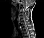 Сможет ли встать на ноги после травмы спинного мозга (МРТ) фото 3