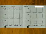 Расшифровка кардиограммы после болей фото 3