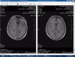 Заболевание сосудов головного мозга фото 3