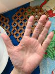 Жжение и микротрещины пальцев рук фото 3