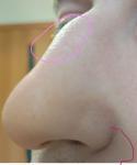 Краснота на уголках губ, около крыльев носа, ниже нижней губы фото 3