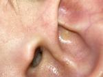 Новообразование на хряще ушной раковины фото 3