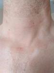 Раздражение кожи на шее и груди после бритья фото 3