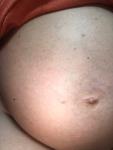 Сыпь на животе при беременности фото 2