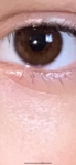 Белая полоска после лопнувшего капилляра о радужке глаза фото 1
