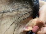 Атерома уха из-за сережек фото 1