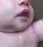 У младенца снизу губы внутренний прыщик, уже месяц не проходит фото 1