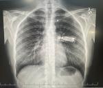 Посмотрите пожалуйста снимок рентгена грудной клетки фото 2