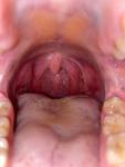 Увеличение правой миндалины, болезненных ощущений в горле нет, планирую беременность фото 1