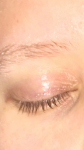 Воспаление глаз фото 1