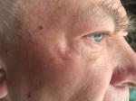 Возможность лечения многолетнего нароста на коже у глаза фото 3