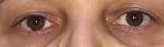 Разный размер глаз как синдром Горнера фото 2