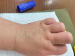 Болячка сухая на руке у малыша фото 1