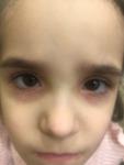 Помогите, как лечить аллергию вокруг глаз ребёнку фото 1