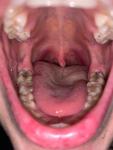 Ощущение инородного тела в левой части горла. Опасаюсь рака! фото 3