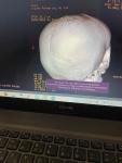 Деформация черепа фото 1