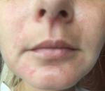 Красная сыпь около рта и носа с белыми пузырьками фото 1