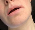 Заеда в уголке губ, воспаление лимфоузла фото 2