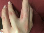 Кожа на пальцах рук воспалена фото 3