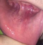 Болячка на обратной стороне губы фото 1