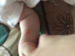 Сыпь на руках у ребёнка большие прыщи фото 1