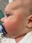 Высыпание на щечках у ребенка в 4 месяца фото 3
