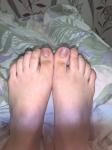 Темные пятна на больших пальцах ног фото 1