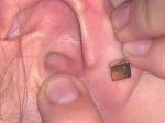 Боль в ушной раковине фото 2