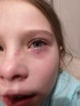 Воспаление глаза у ребёнка и покраснение фото 1