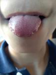 Воспаление языка, пупырышки на кончике языка фото 2
