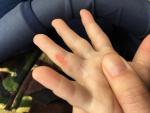 Болячка на пальцах отсутствует верхний слой у малыша фото 3