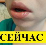 Травма губы (последствия спустя месяц) фото 18+ фото 4