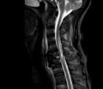 Сможет ли встать на ноги после травмы спинного мозга (МРТ) фото 4