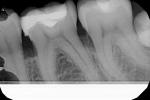 Зуб болит пришеечный кариес фото 1