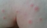 Сыпь в виде комариных укусов фото 4