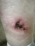 Рваная рана на ноге фото 2