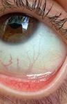 Пожелтение в белках глаза после линз фото 2