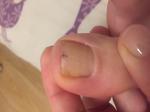Чёрная полоска на ногте большого пальца ноги фото 2