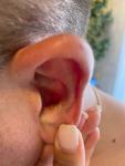Кожные заболевания на ушной раковине фото 2