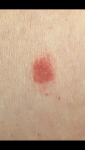 Красное шершавое пятно на ноге фото 4