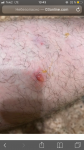 Инфекционный дерматит фото 1