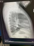 Пневмония или нет в сегменте s8 правое лёгкое фото 3