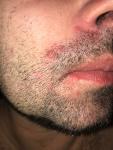 Воспаления кожи в области усов и подбородка фото 2