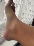 Сильная боль в голеностопе, невозможно наступить на ногу фото 2
