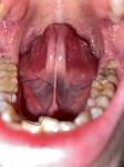 Рак языка, под языком образовались бугорки фото 1