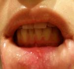 Воспаление на слизистой нижней губы фото 1