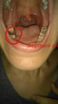 Повреждение десны после свища, воспаление щеки и горло фото 4