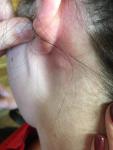 Уплотнение в виде шишки за ухом сзади фото 1