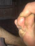 Чёрные точки на пальцах ног фото 1